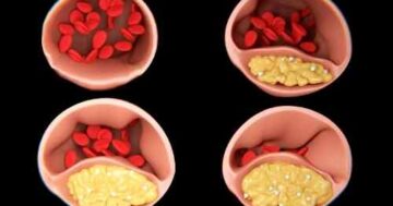 ไขมันในเลือดผิดปกติ