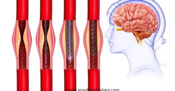 โรคหลอดเลือดสมอง