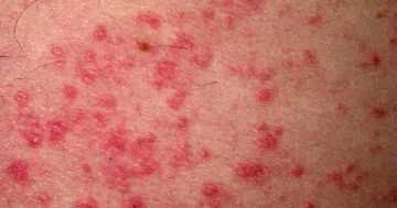 ภูมิแพ้ผิวหนัง