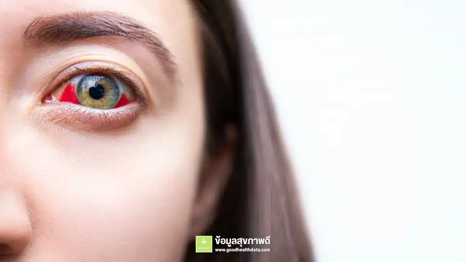 เบาหวานขึ้นตา ดูแลสุขภาพตาให้ดีก่อนสูญเสียการมองเห็น